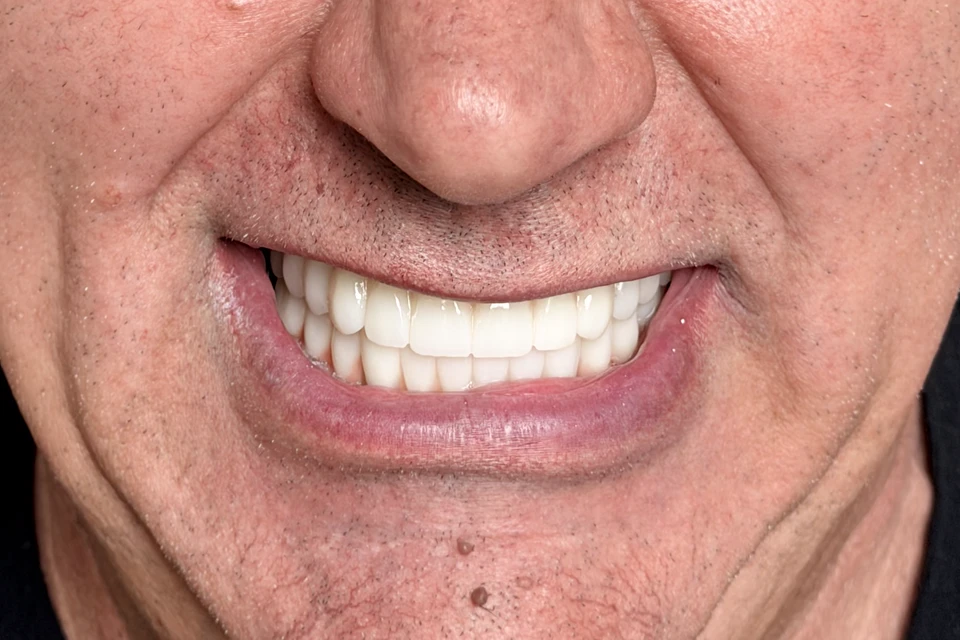 Cazul 1, fotografie după, Dentalix