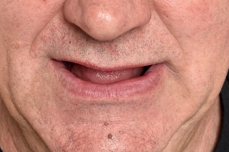 Cazul 1, fotografie înainte, Dentalix