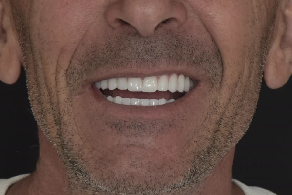 Cazul 4, fotografie după, Dentalix