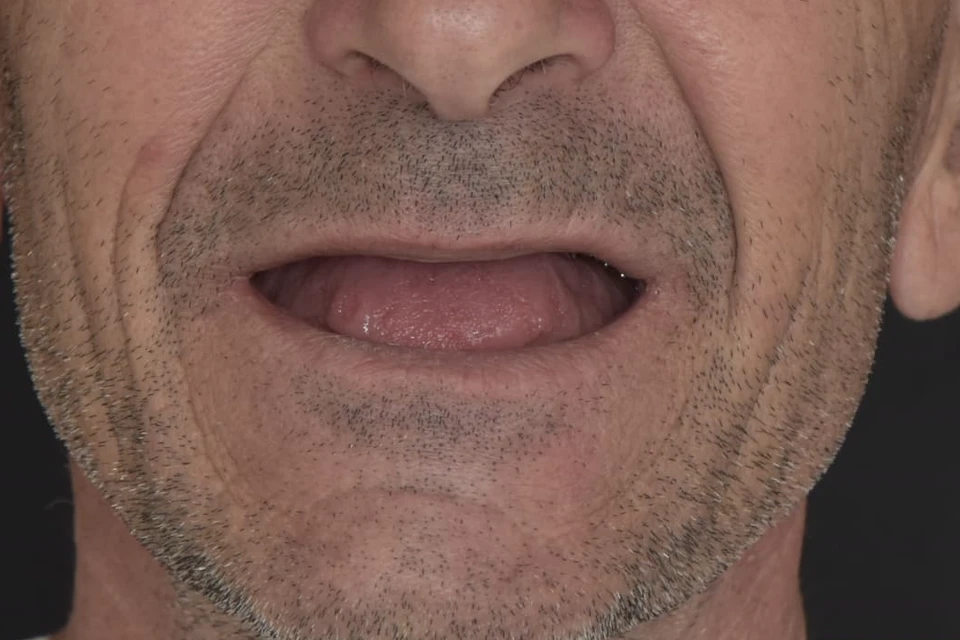 Cazul 4, fotografie înainte, Dentalix