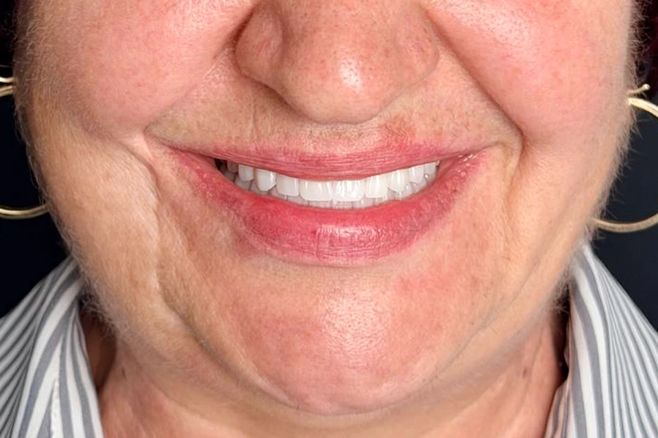 Cazul 2, fotografie după, Dentalix
