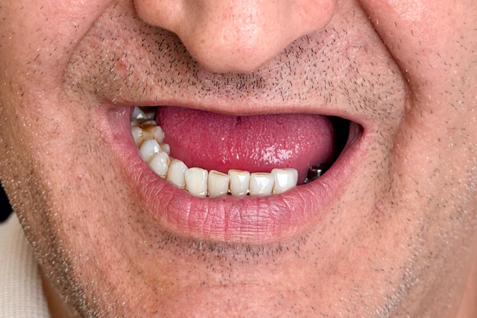 Cazul 3, fotografie înainte, Dentalix
