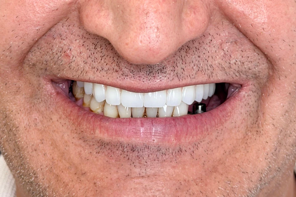 Cazul 3, fotografie după, Dentalix