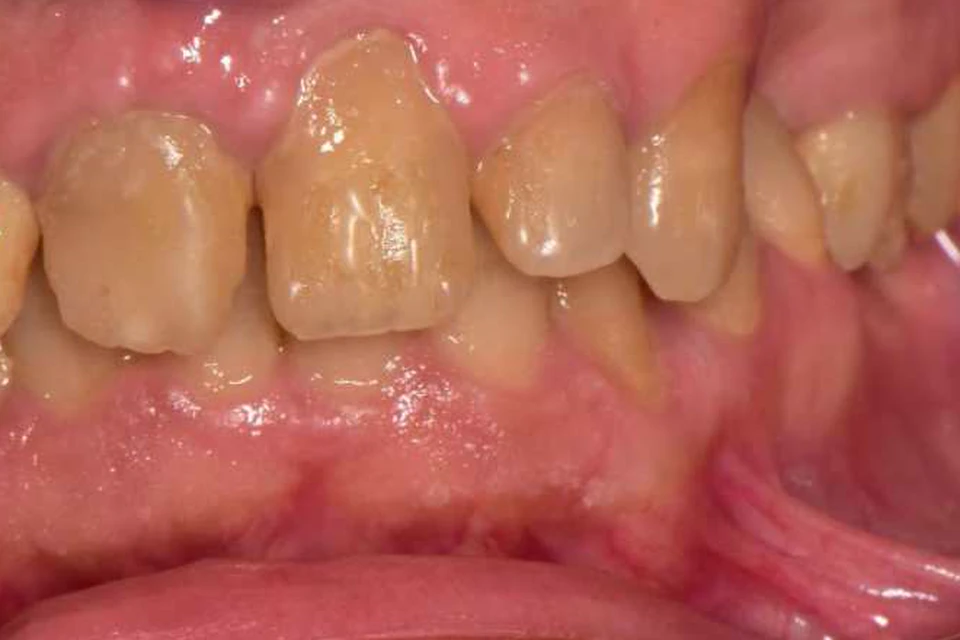 Cazul 6, fotografie înainte, Dentalix