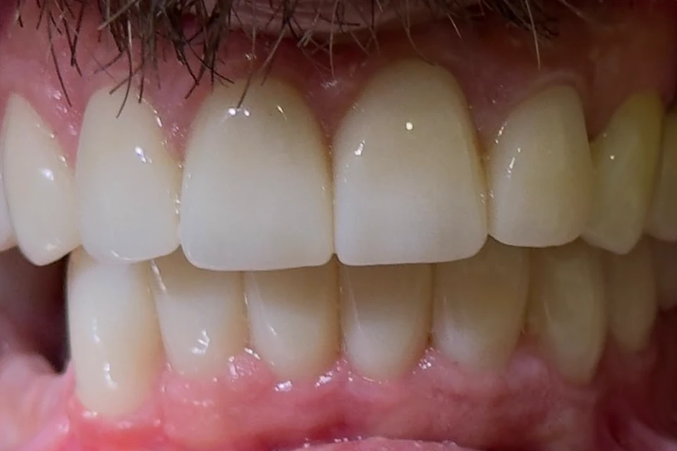 Cazul 6, fotografie după, Dentalix