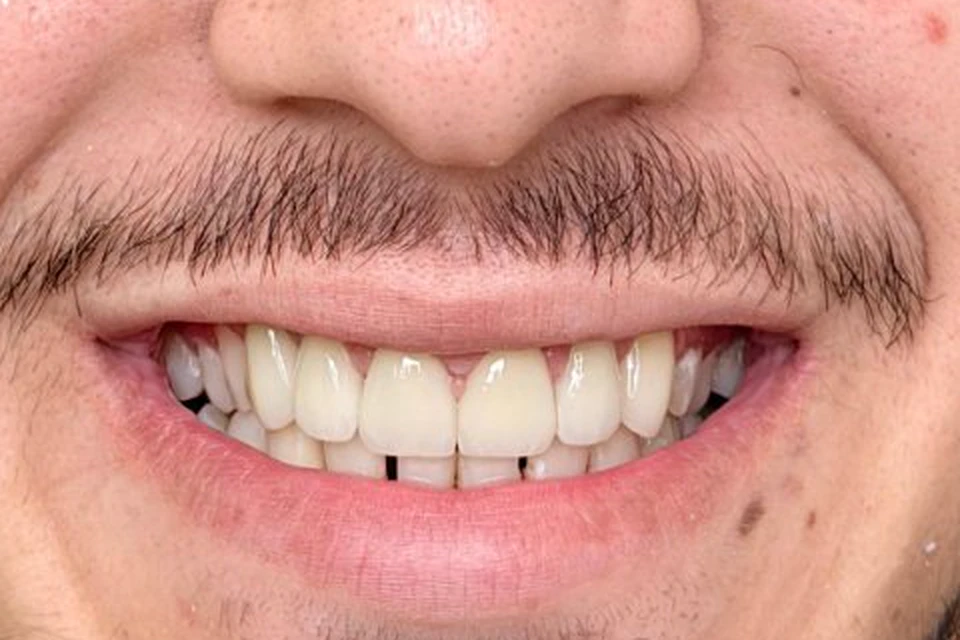 Cazul 7, fotografie după, Dentalix