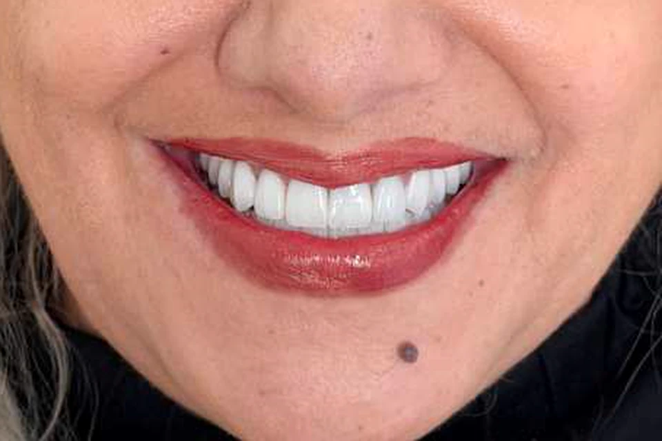 Cazul 8, fotografie după, Dentalix