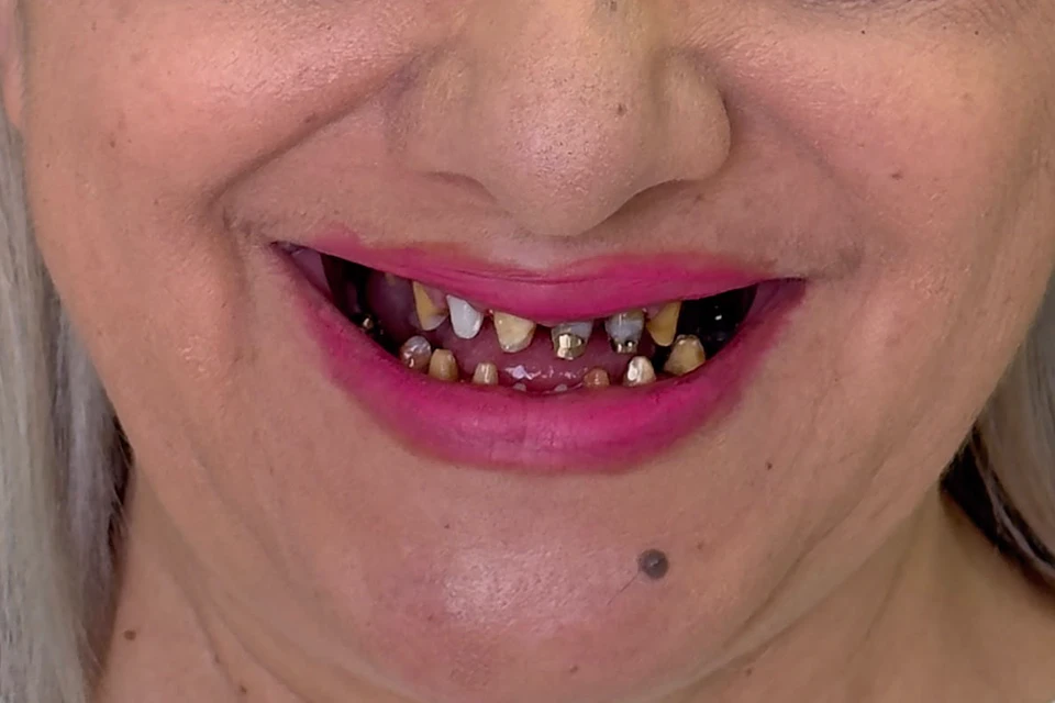 Cazul 8, fotografie înainte, Dentalix