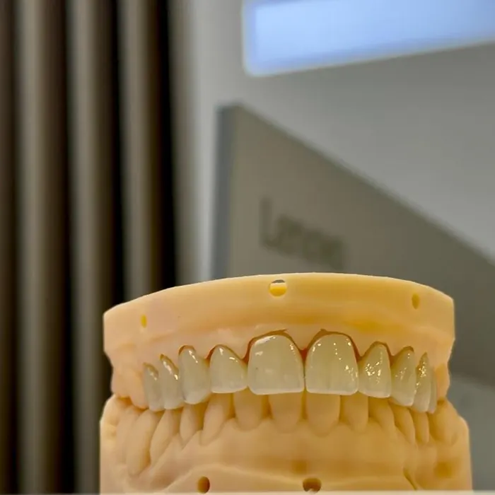 Model de studiu cu lucrare protetică pe dinții din față, fotografiat în clinica Dentalix Băicoi