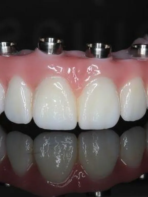 Coroane și proteze, protetică dentară la Dentalix Topoloveni și Băicoi